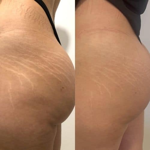 Side-by-side comparison of forearm skin showing fine lines and redness on the left, and smoother, less red skin on the right. I Stretch Mark & Scar Treatment Perth Clinic