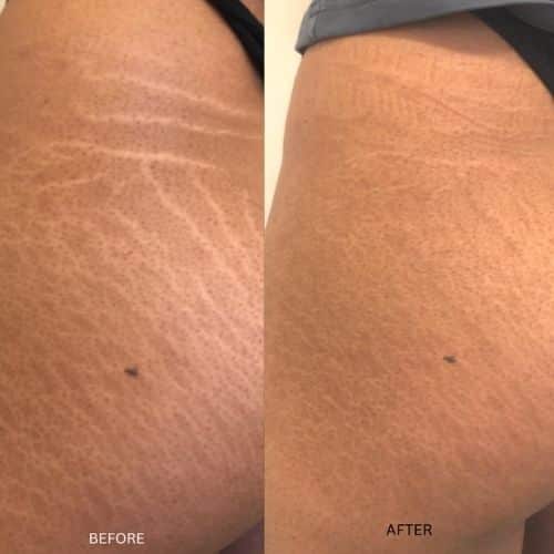 Two close-up images of a person's abdomen showing stretch marks; the top image shows more visible marks, while the bottom image shows marks that appear lighter and less noticeable. I Stretch Mark & Scar Treatment Perth Clinic