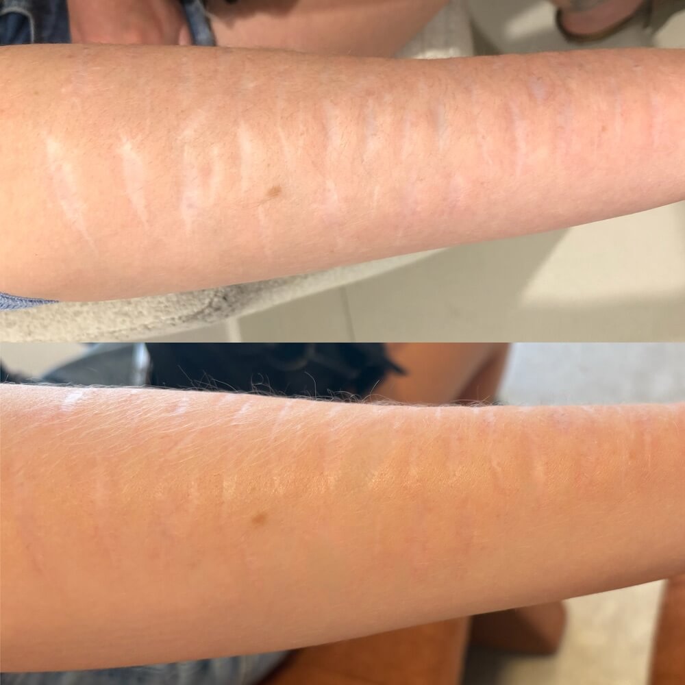 Before & After Stretchmark & Scar Revision Perth