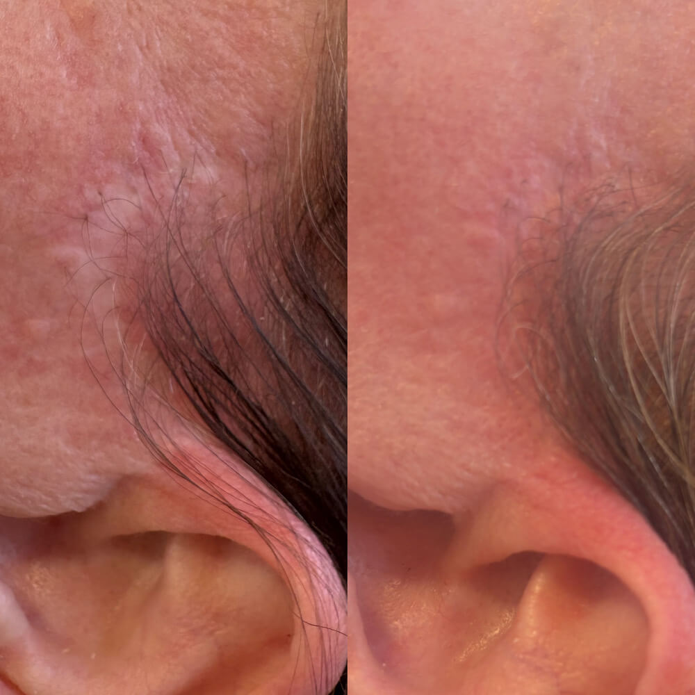 Before & After Stretchmark & Scar Revision Perth