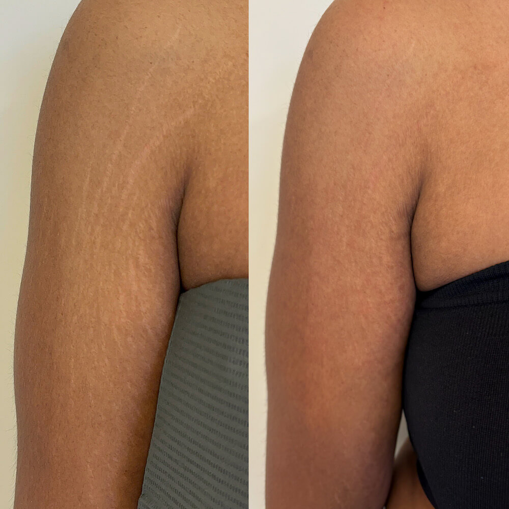 Before & After Stretchmark & Scar Revision Perth
