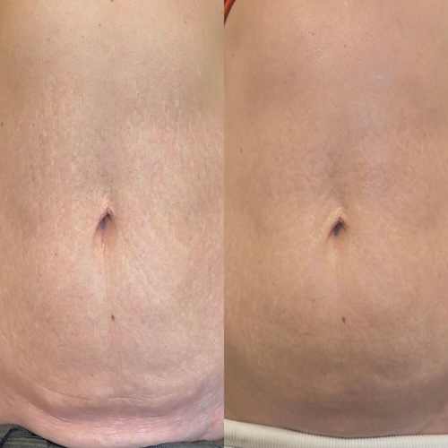 Before & After Stretchmark & Scar Revision Perth